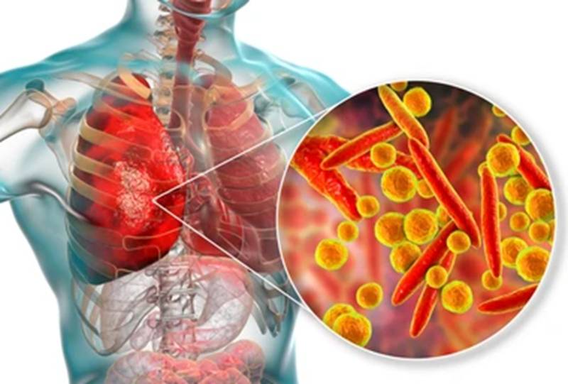AUGMENTATION DES CAS D’INFECTIONS RESPIRATOIRES A MYCOPLASMA PNEUMONIAE EN FRANCE